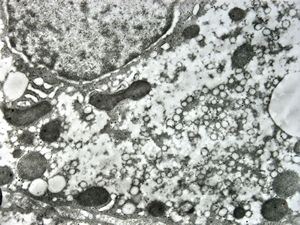 F,1y. | glycogenosis type II. (glycogen dissolved due to UA blockstaining)